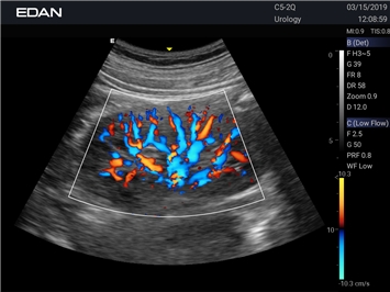 EDAN Acclarix LX25