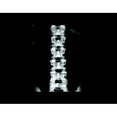 Рентгеновский костный денситометр GE Lunar iDXA