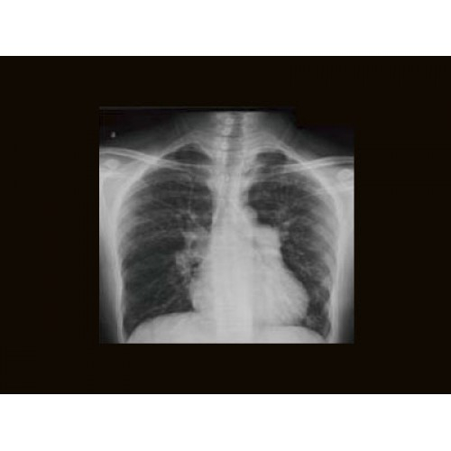 Цифровой рентген аппарат GE Brivo XR575